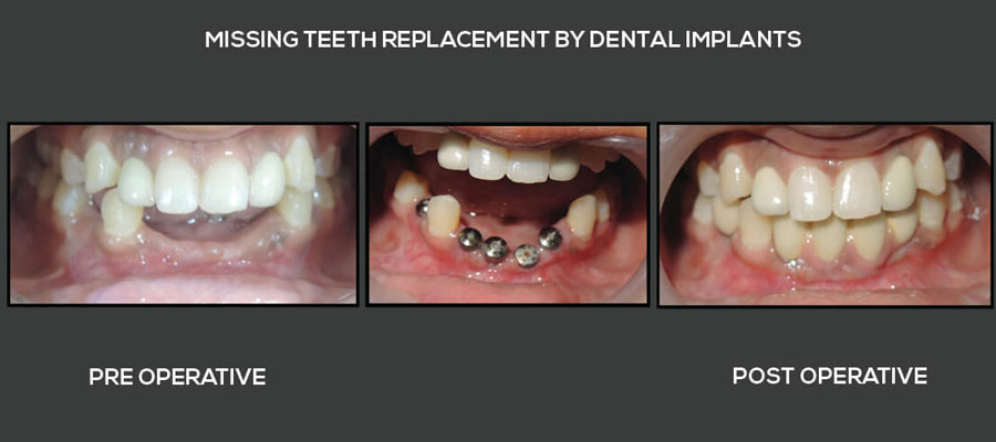teeth replacement 3