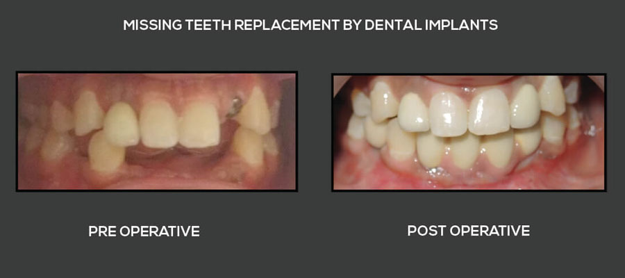 teeth replacement